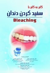 گام به گام با سفید کردن دندان Bleaching