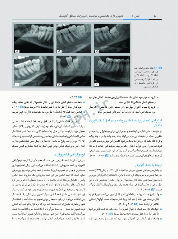 جراحی پیزوالکتریک دندان‌های نهفته