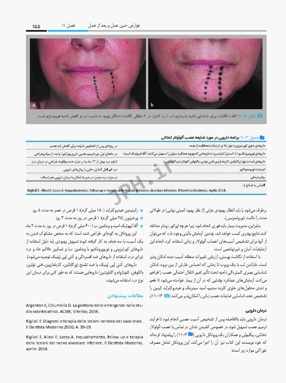 جراحی پیزوالکتریک دندان‌های نهفته