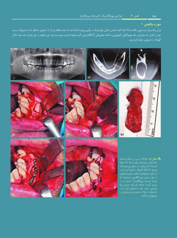 جراحی پیزوالکتریک دندان‌های نهفته