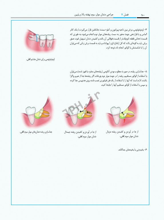 جراحی پیزوالکتریک دندان‌های نهفته