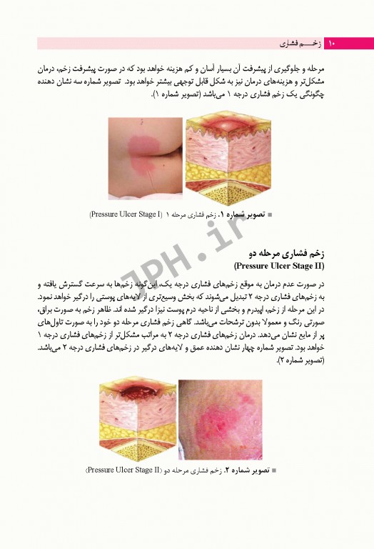زخم فشاری پیشگیری، درمان و مراقبت‌های پرستاری