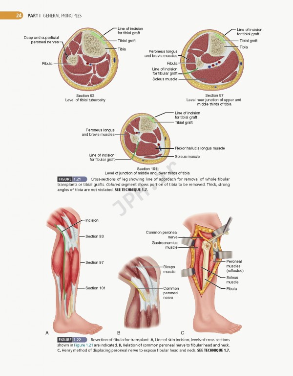 ارتوپدی عملی کمپبل 4جلدی 2021 | Campbell's Operative Orthopaedics 14th edition 4-volum
