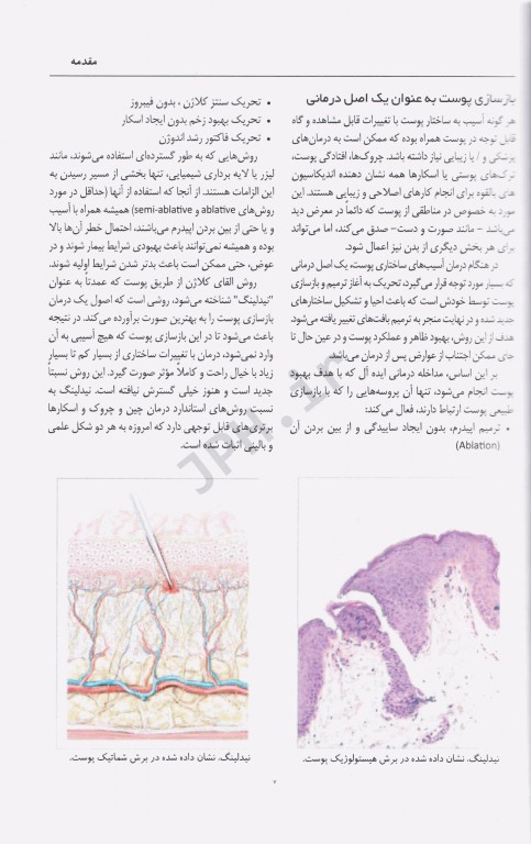 راهنمای تصویری القای کلاژن سازی زیرجلدی