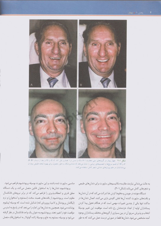 درمان پروتزی برای بیماران بی‌دندان زارب 2013