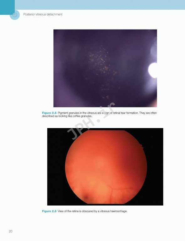 اختلالات زجاجیه شبکیه در مراقبت‌های اولیه | Vitreoretinal Disorders in Primary Care