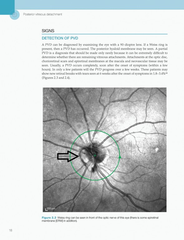 اختلالات زجاجیه شبکیه در مراقبت‌های اولیه | Vitreoretinal Disorders in Primary Care