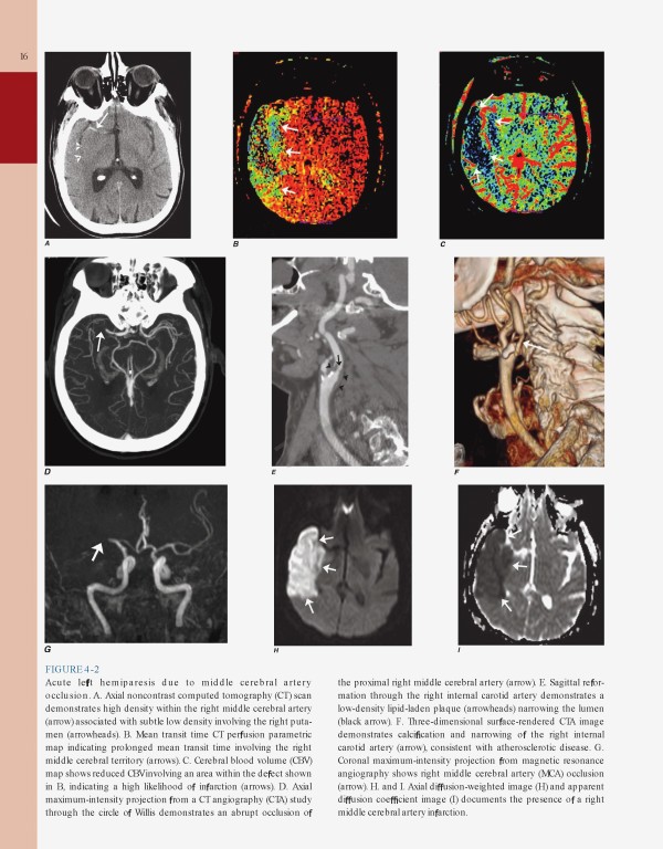 مغز و اعصاب در پزشکی بالینی هاریسون 2018 | Harrisons Neurology in Clinical Medicine 4th edition