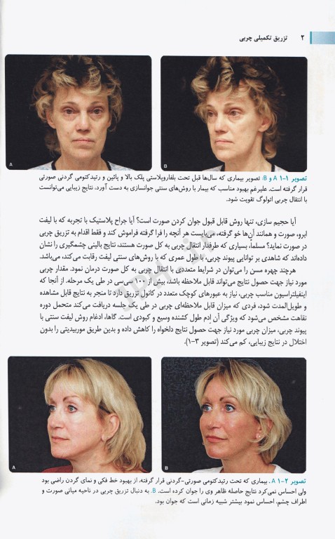 تزریق تکمیلی چربی همراه با DVD آموزشی دکتر فرزان