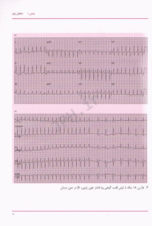 EKG های شایع 2 برای پزشکان