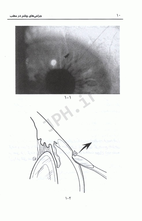 شرح گام به گام جراحی‌های چشم در مطب