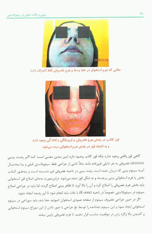 بینی و نکات عملی در رینوپلاستی