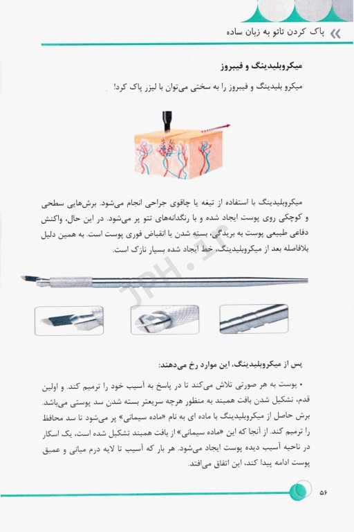 تتو ریمووال به زبان ساده