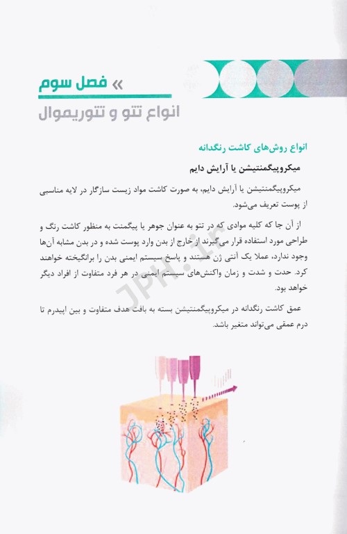 تتو ریمووال به زبان ساده