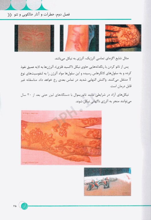 تتو ریمووال به زبان ساده