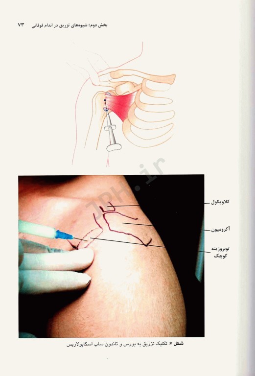 اصول و روش‌های تزریق مفصلی و موضعی