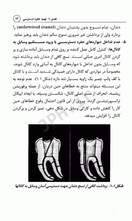 آموزش گام به گام درمان ریشه دندان