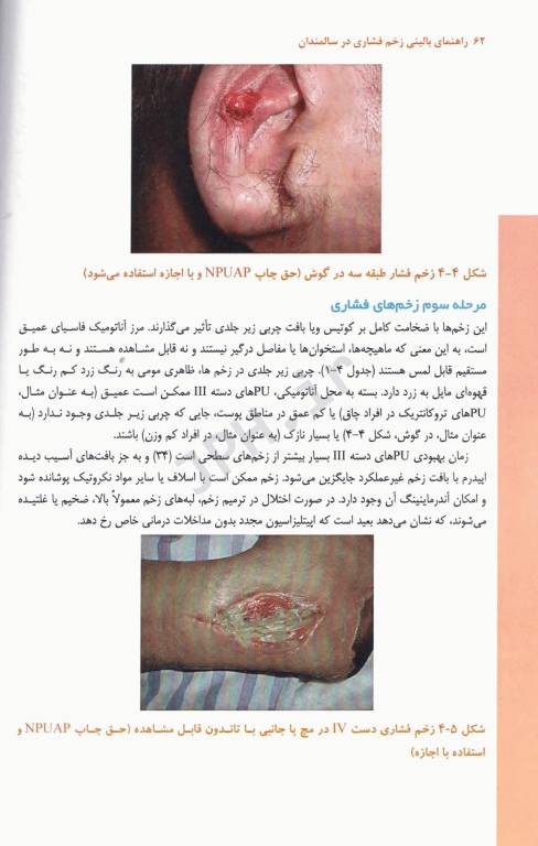 راهنمای بالینی زخم فشاری در سالمندان