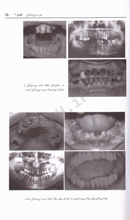 درمان بیماران بدون دندان پروتز کامل (1)