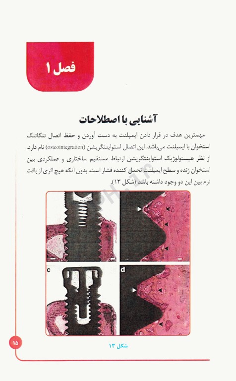 ایمپلنت و لیزر در دندانپزشکی به زبان ساده