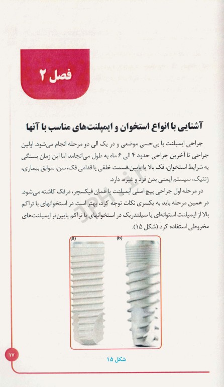 ایمپلنت و لیزر در دندانپزشکی به زبان ساده