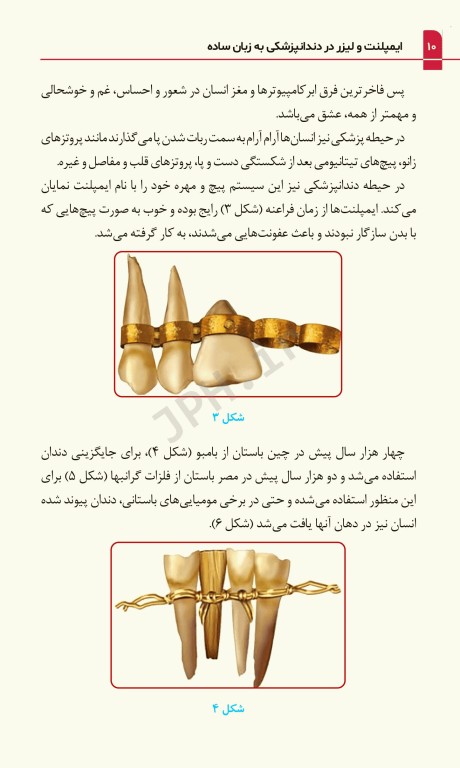 ایمپلنت و لیزر در دندانپزشکی به زبان ساده