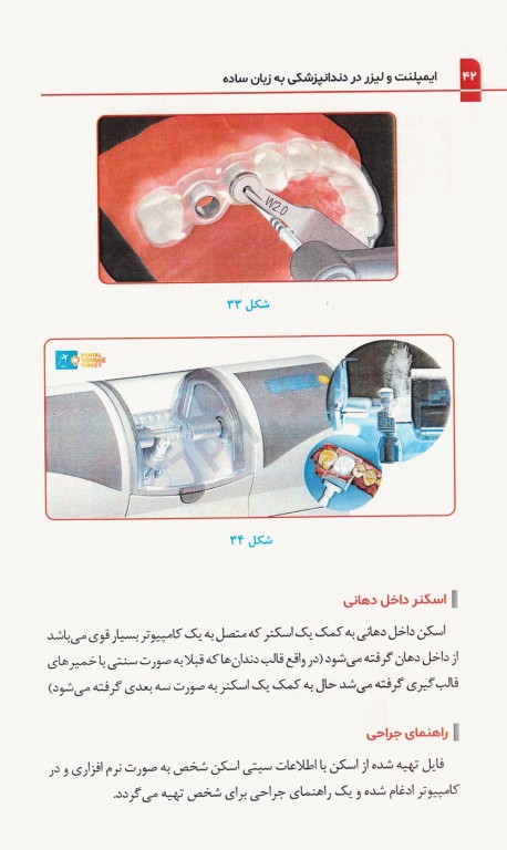 ایمپلنت و لیزر در دندانپزشکی به زبان ساده