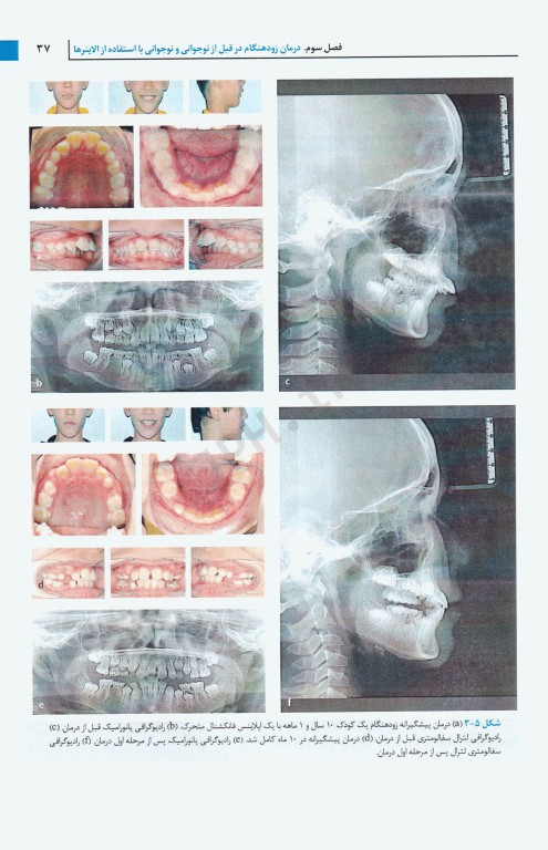 درمان ارتودنسی با الاینر مروری بر مواد، مدیریت بالینی و شواهد 2021