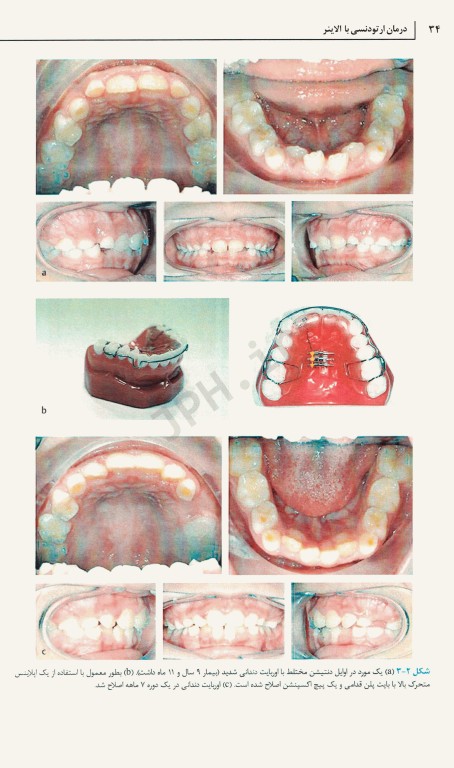 درمان ارتودنسی با الاینر مروری بر مواد، مدیریت بالینی و شواهد 2021