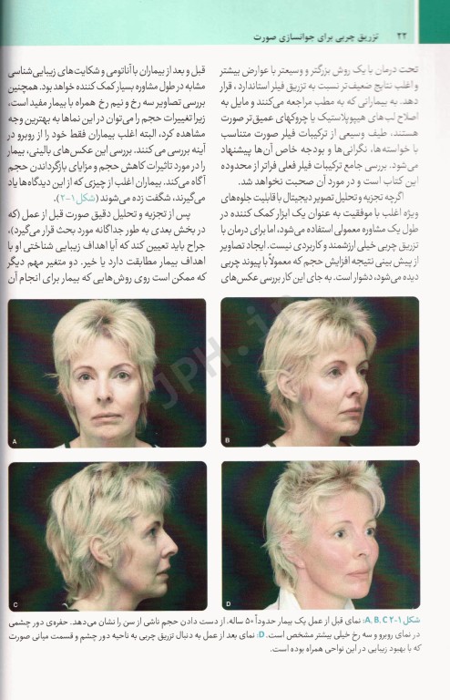 تزریق چربی برای جوانسازی صورت ترجمه دکتر داوود رمزی