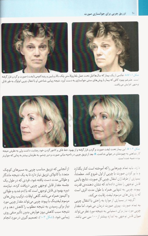 تزریق چربی برای جوانسازی صورت ترجمه دکتر داوود رمزی