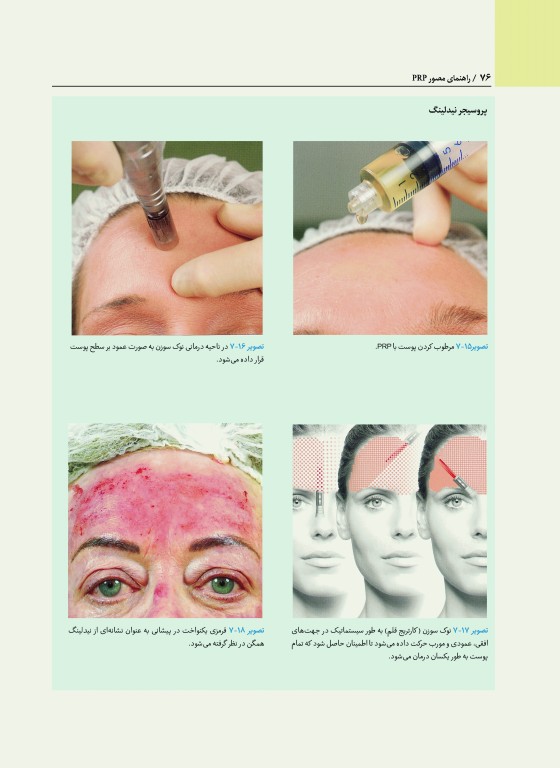 راهنمای مصور PRP دکتر داوود رمزی