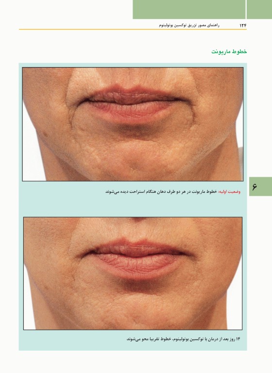 راهنمای مصور تزریق توکسین بوتولینوم دکتر داوود رمزی