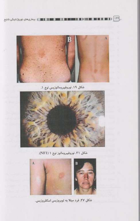 نوروپاتی‌های شایع ژنتیکی