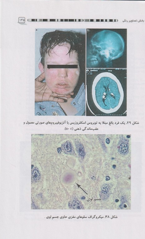 نوروپاتی‌های شایع ژنتیکی