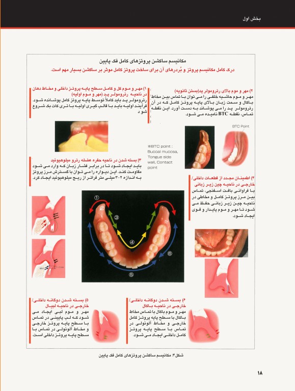 ساکشن پروتز کامل فک پایین بصورت پیشرفته