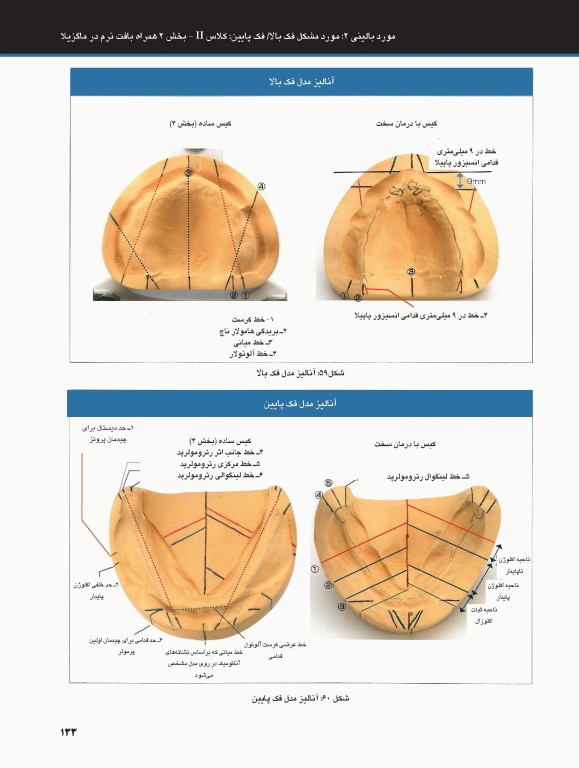 ساکشن پروتز کامل فک پایین بصورت پیشرفته