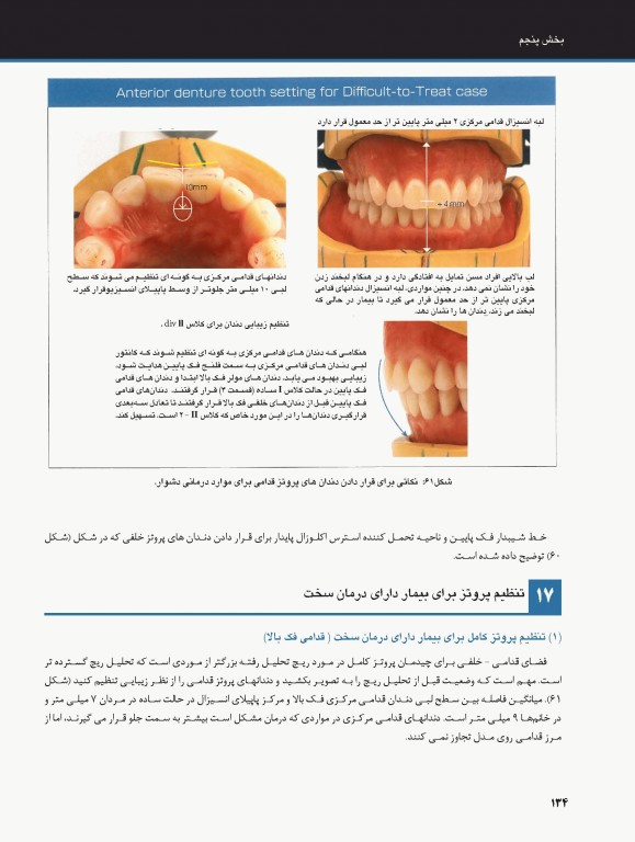 ساکشن پروتز کامل فک پایین بصورت پیشرفته
