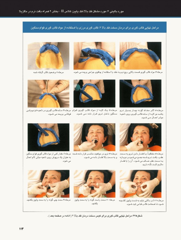 ساکشن پروتز کامل فک پایین بصورت پیشرفته