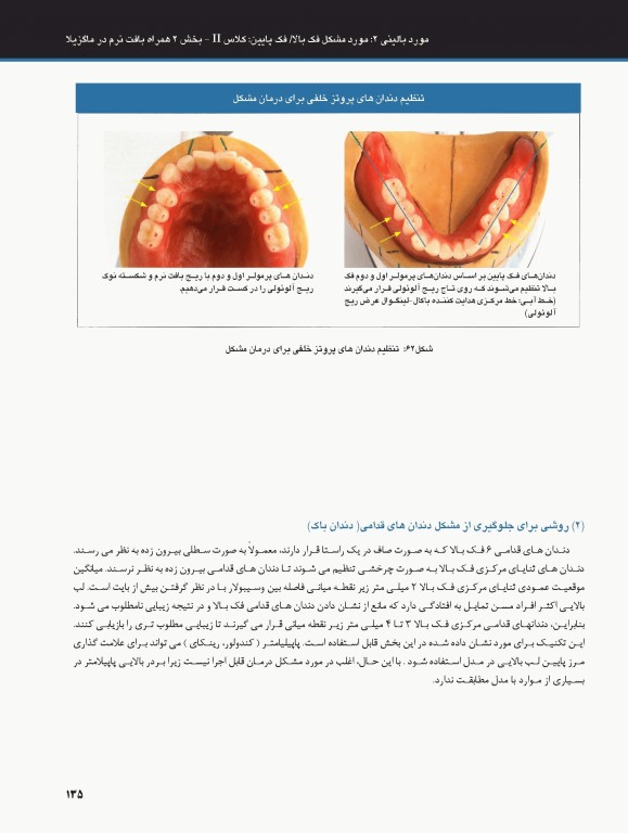 ساکشن پروتز کامل فک پایین بصورت پیشرفته