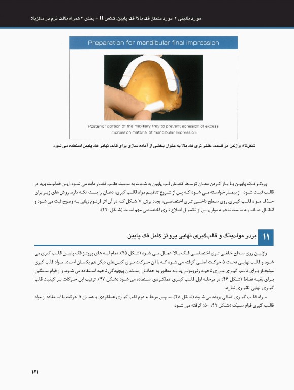 ساکشن پروتز کامل فک پایین بصورت پیشرفته