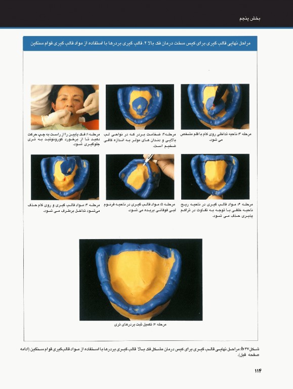 ساکشن پروتز کامل فک پایین بصورت پیشرفته