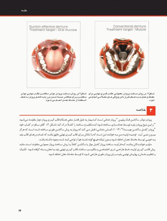 ساکشن پروتز کامل فک پایین بصورت پیشرفته