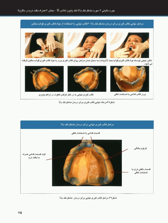 ساکشن پروتز کامل فک پایین بصورت پیشرفته