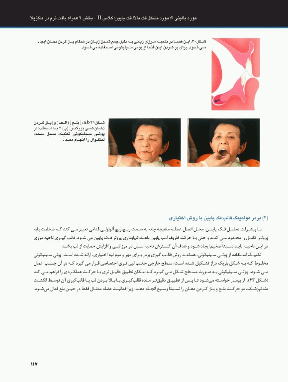 ساکشن پروتز کامل فک پایین بصورت پیشرفته