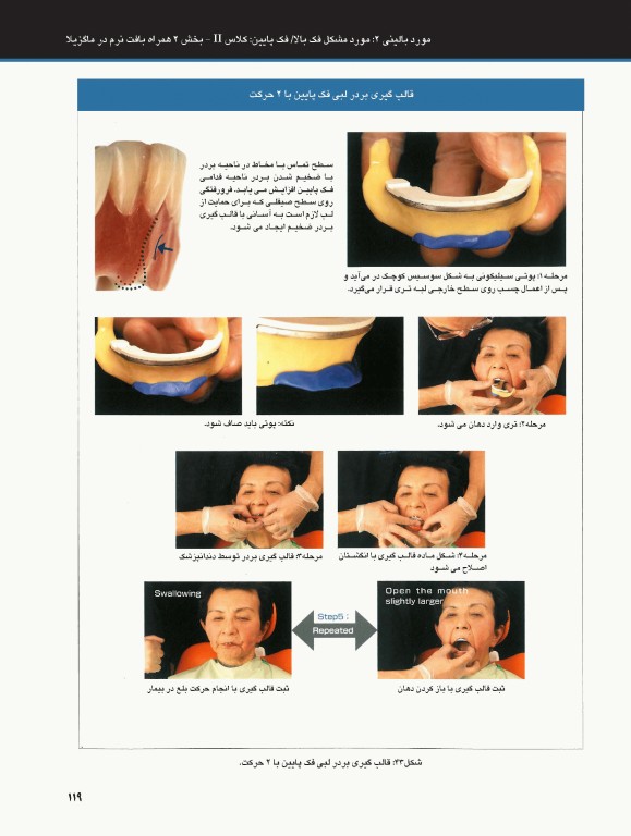 ساکشن پروتز کامل فک پایین بصورت پیشرفته