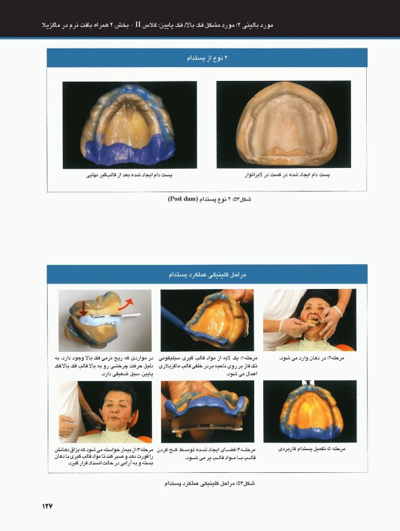 ساکشن پروتز کامل فک پایین بصورت پیشرفته