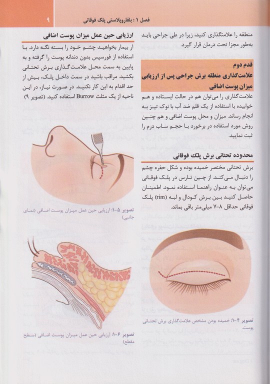 بلفاروپلاستی و لیفت آندوسکوپیک پیشانی