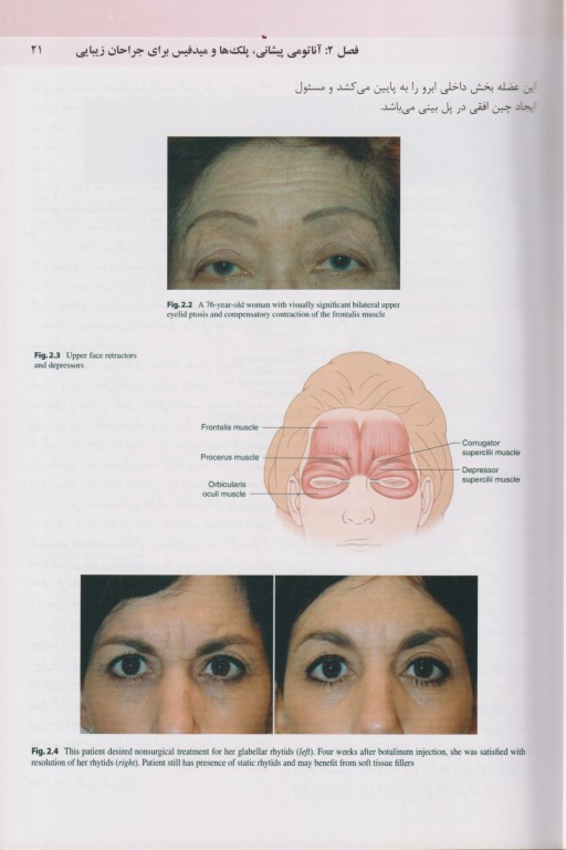 تکنیک‌های اصلی بلفاروپلاستی و جوان‌سازی پری‌اربیتال