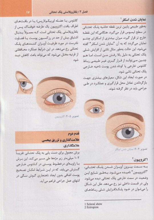 بلفاروپلاستی و لیفت آندوسکوپیک پیشانی